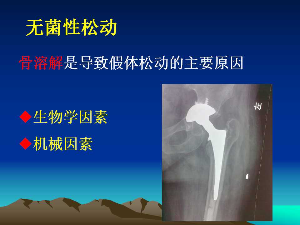 全髋关节翻修的原因及处理策略