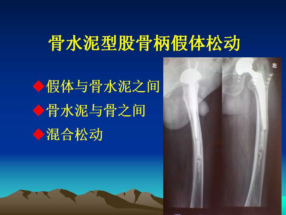 全髋关节翻修的原因及处理策略