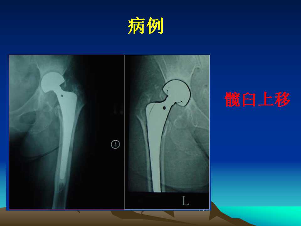 全髋关节翻修的原因及处理策略