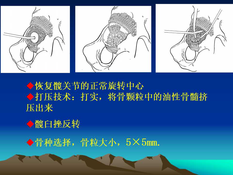 全髋关节翻修的原因及处理策略