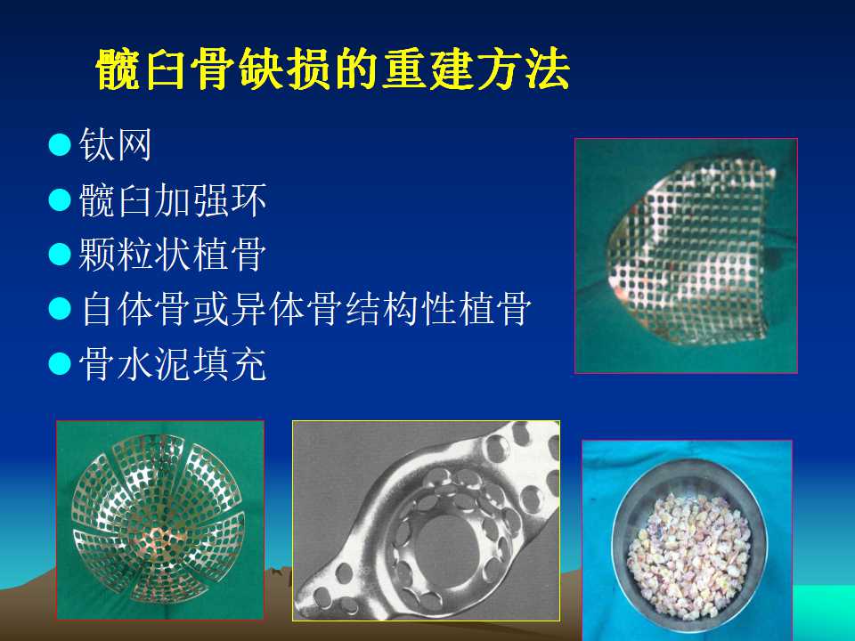 全髋关节翻修的原因及处理策略