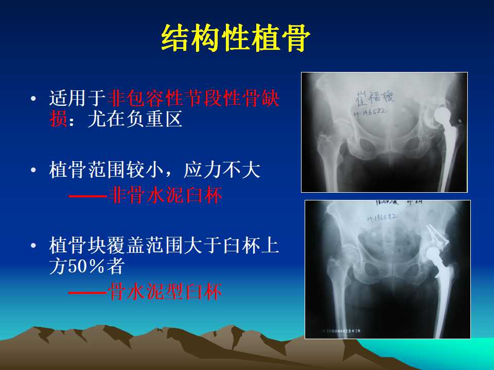 全髋关节翻修的原因及处理策略