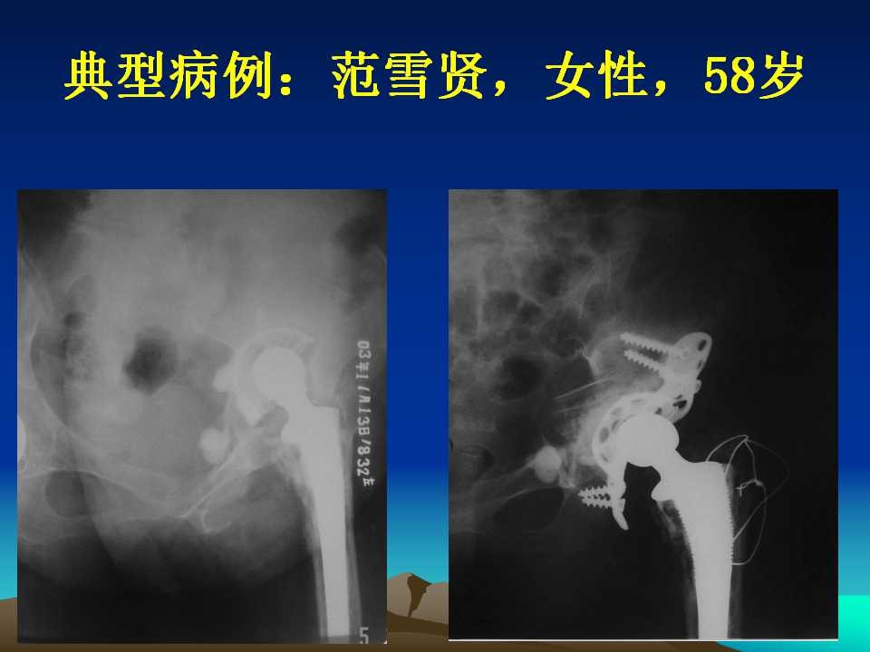 全髋关节翻修的原因及处理策略