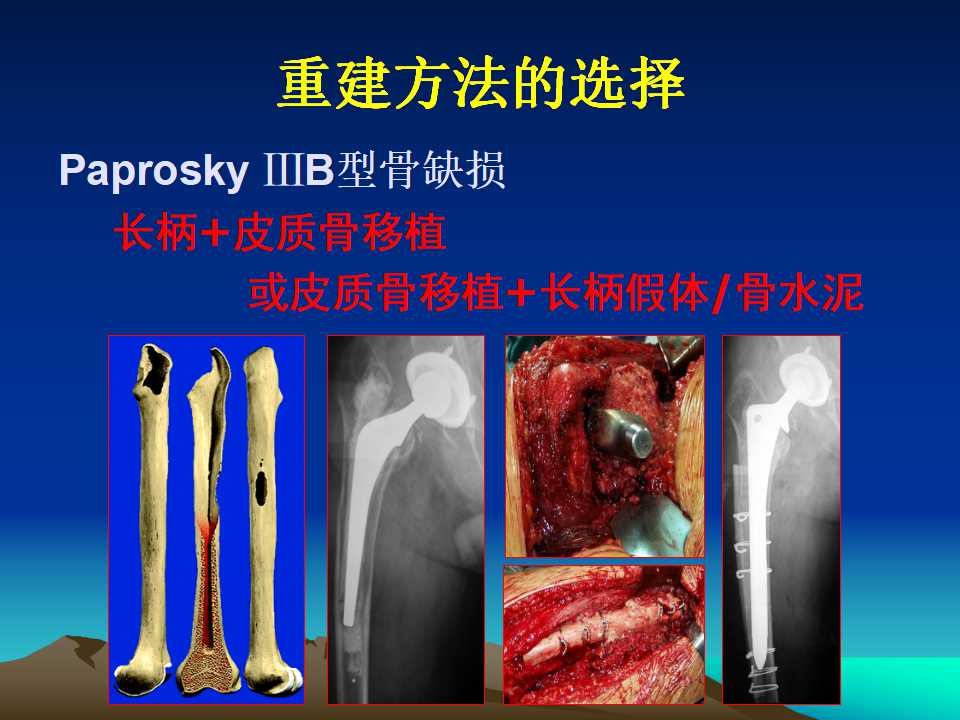 全髋关节翻修的原因及处理策略