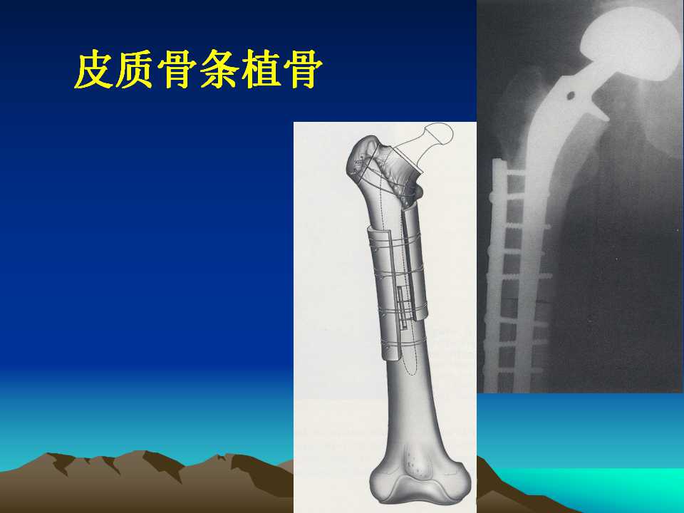 全髋关节翻修的原因及处理策略