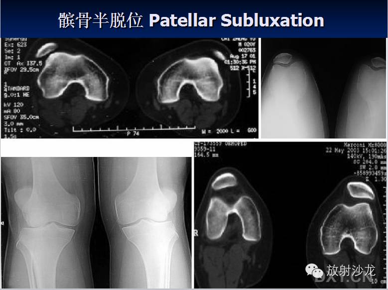 膝关节疼痛的鉴别诊断要点