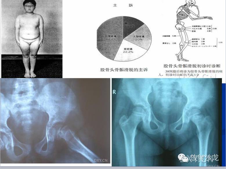 膝关节疼痛的鉴别诊断要点