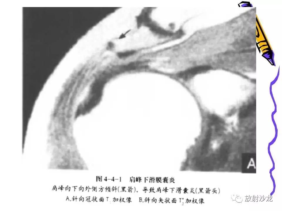 肩关节常见创伤性病变你了解多少？