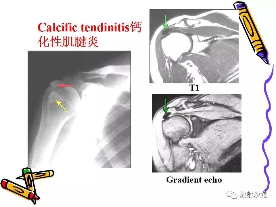 肩关节常见创伤性病变你了解多少？