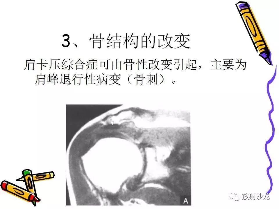 肩关节常见创伤性病变你了解多少？