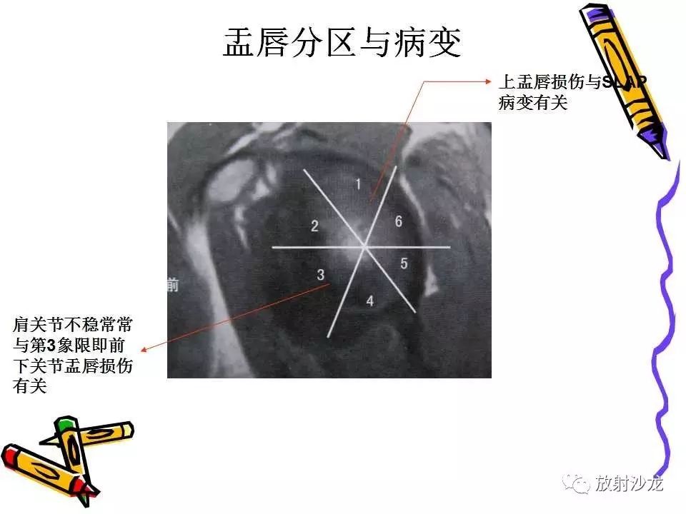 肩关节常见创伤性病变你了解多少？