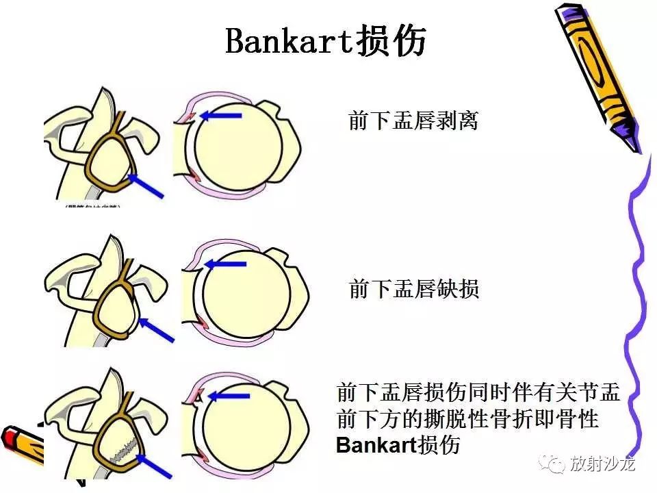 肩关节常见创伤性病变你了解多少？