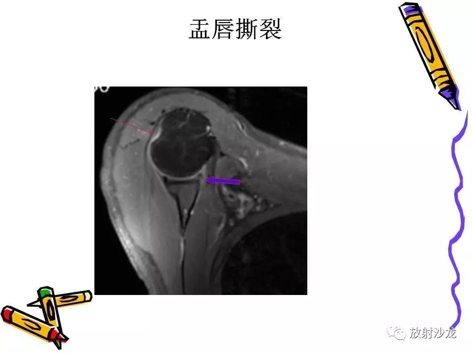 肩关节常见创伤性病变你了解多少？