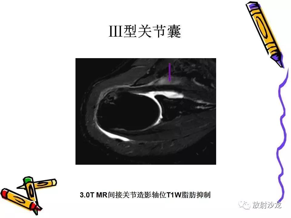 肩关节常见创伤性病变你了解多少？