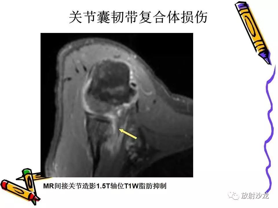 肩关节常见创伤性病变你了解多少？