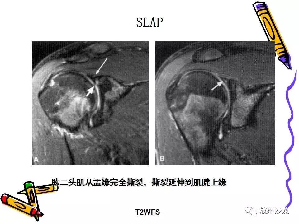 肩关节常见创伤性病变你了解多少？