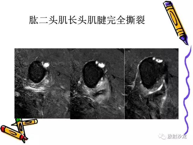 肩关节常见创伤性病变你了解多少？