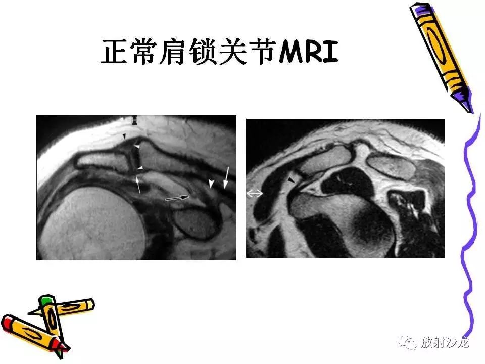 肩关节常见创伤性病变你了解多少？