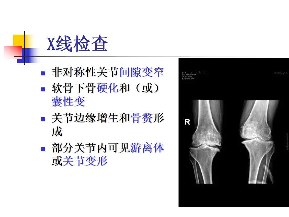 膝骨性关节炎的临床诊治策略