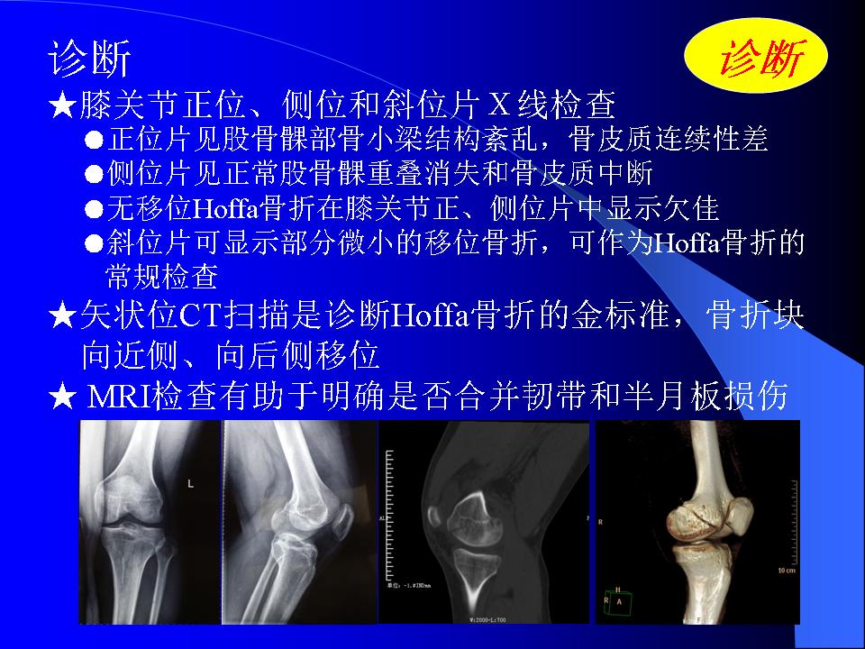 股骨Hoffa骨折的诊断与治疗技巧