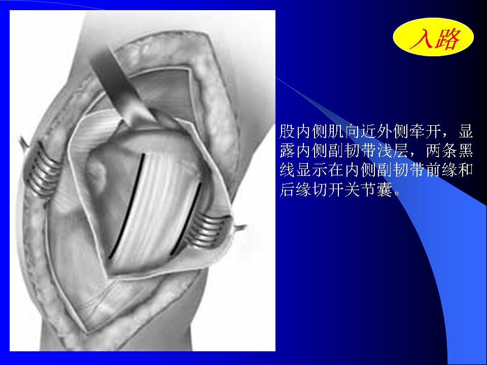 股骨Hoffa骨折的诊断与治疗技巧