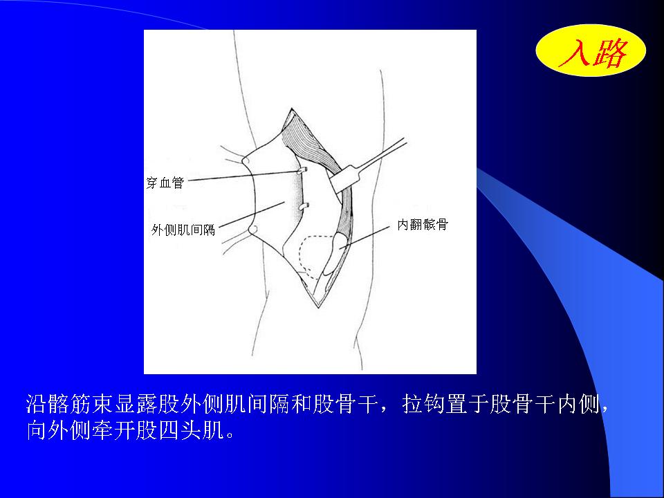 股骨Hoffa骨折的诊断与治疗技巧