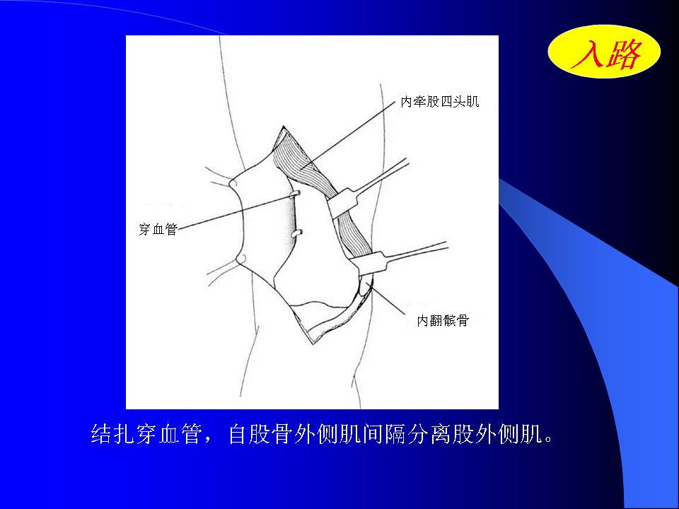 股骨Hoffa骨折的诊断与治疗技巧