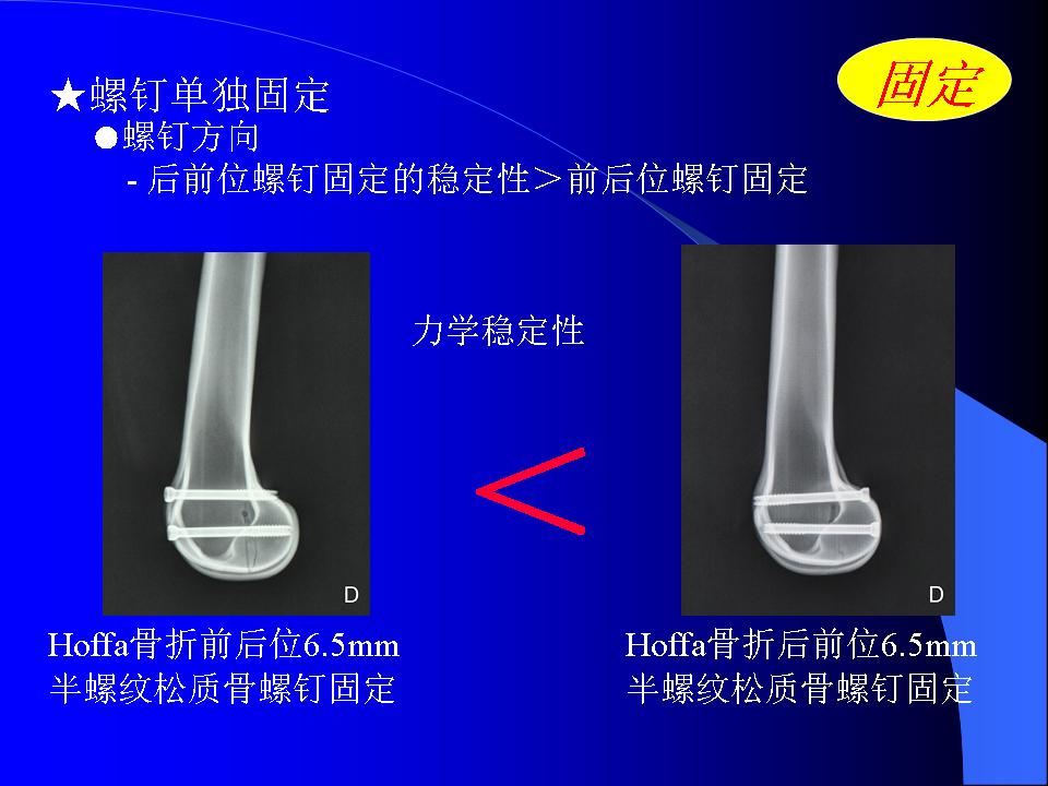 股骨Hoffa骨折的诊断与治疗技巧