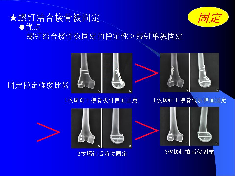 股骨Hoffa骨折的诊断与治疗技巧