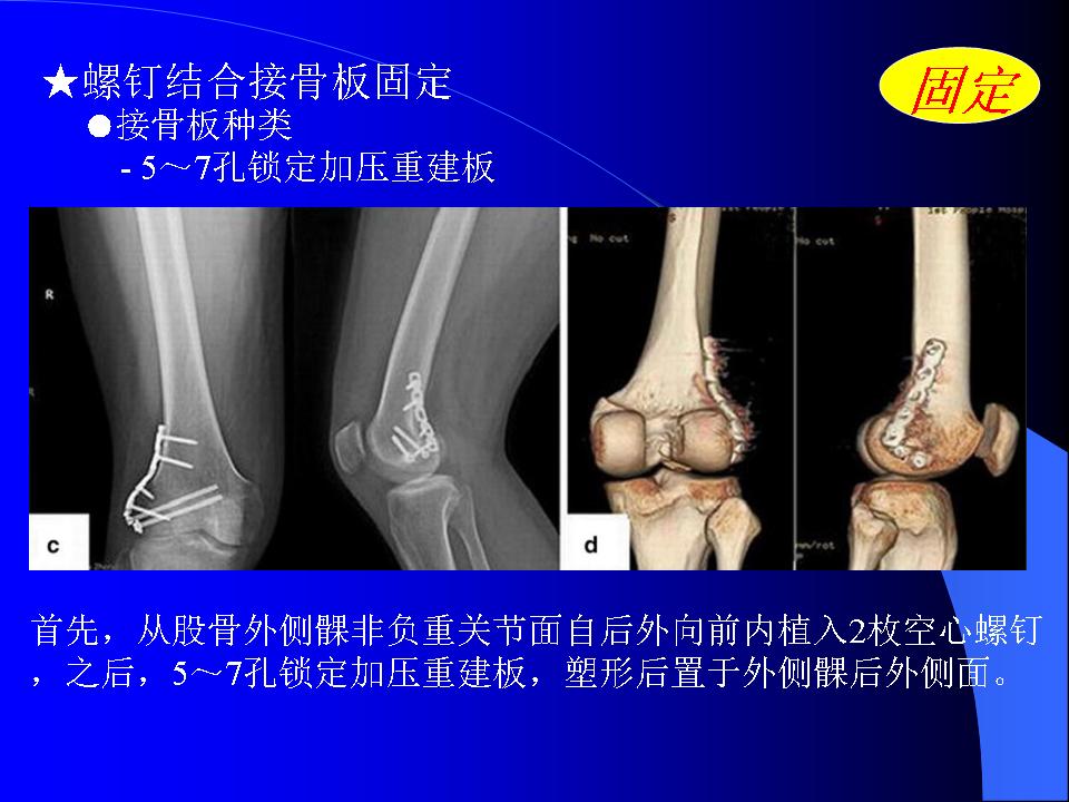 股骨Hoffa骨折的诊断与治疗技巧