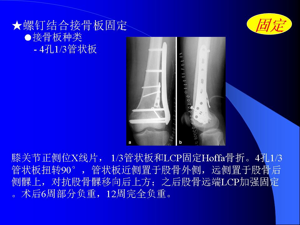 股骨Hoffa骨折的诊断与治疗技巧