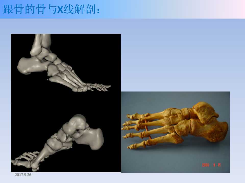 跟骨骨折的临床治疗方式及其要点