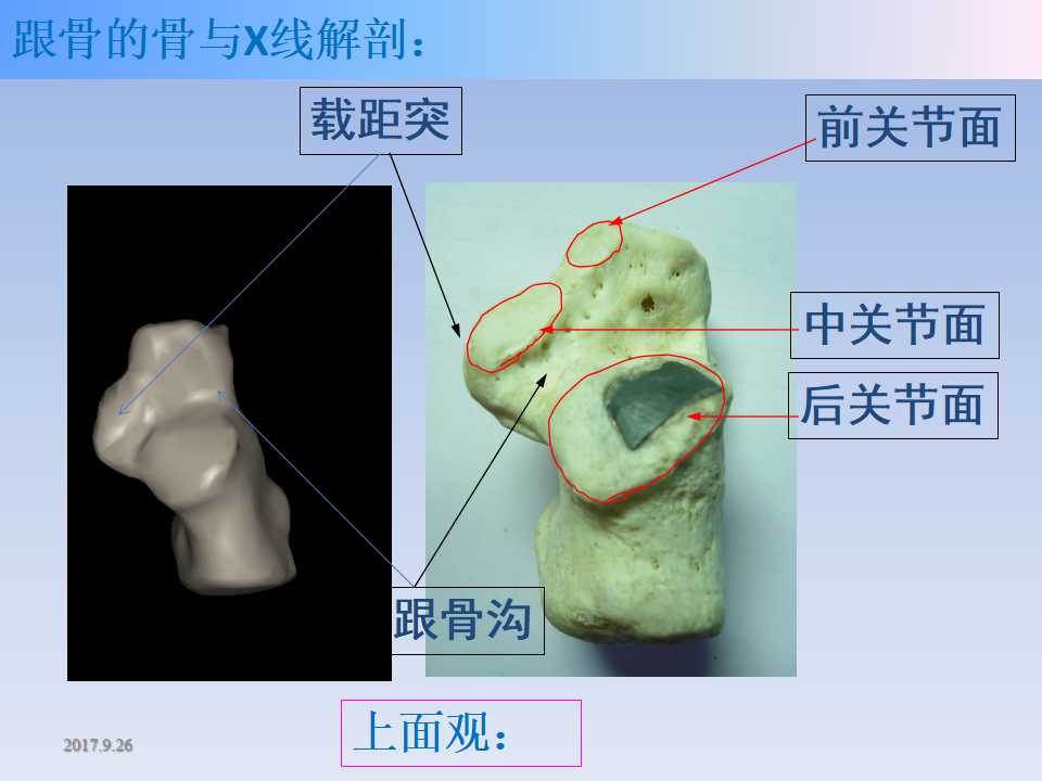 跟骨骨折的临床治疗方式及其要点