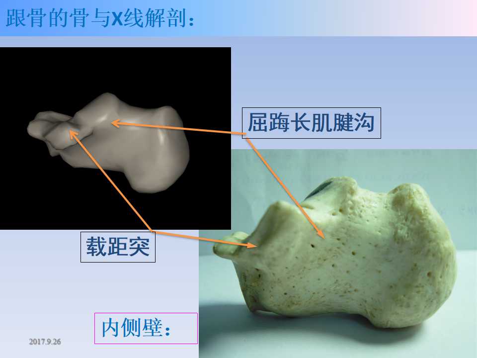 跟骨骨折的临床治疗方式及其要点