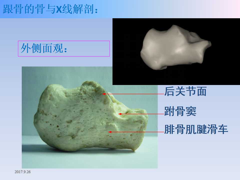 跟骨骨折的临床治疗方式及其要点