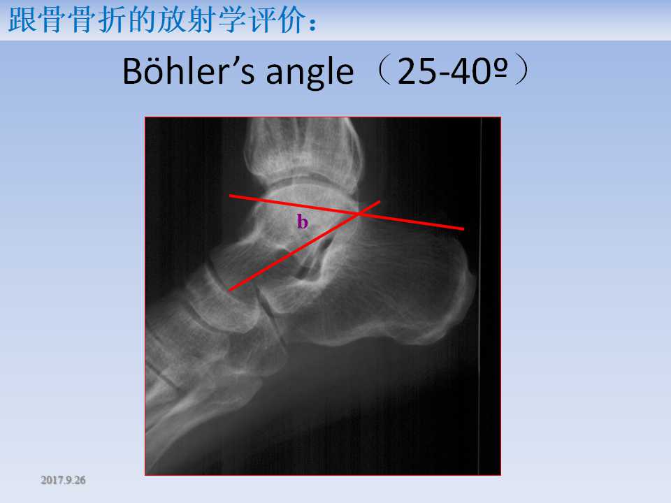 跟骨骨折的临床治疗方式及其要点