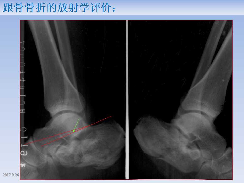 跟骨骨折的临床治疗方式及其要点