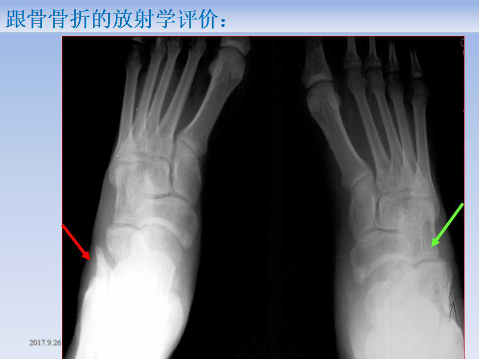 跟骨骨折的临床治疗方式及其要点