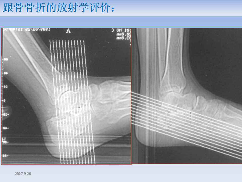 跟骨骨折的临床治疗方式及其要点