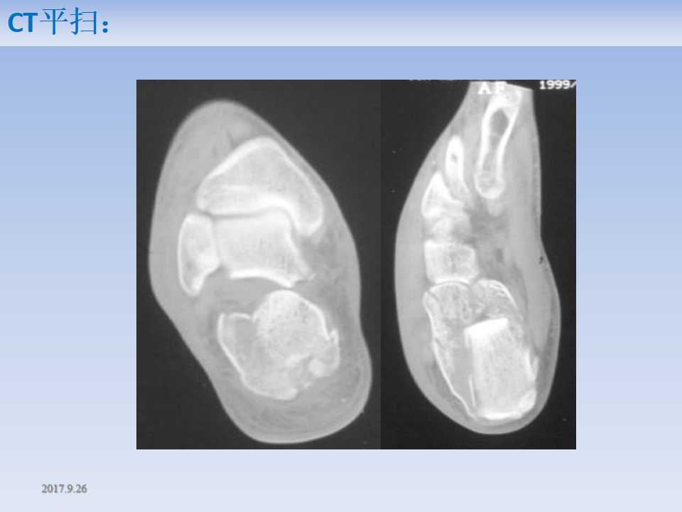 跟骨骨折的临床治疗方式及其要点