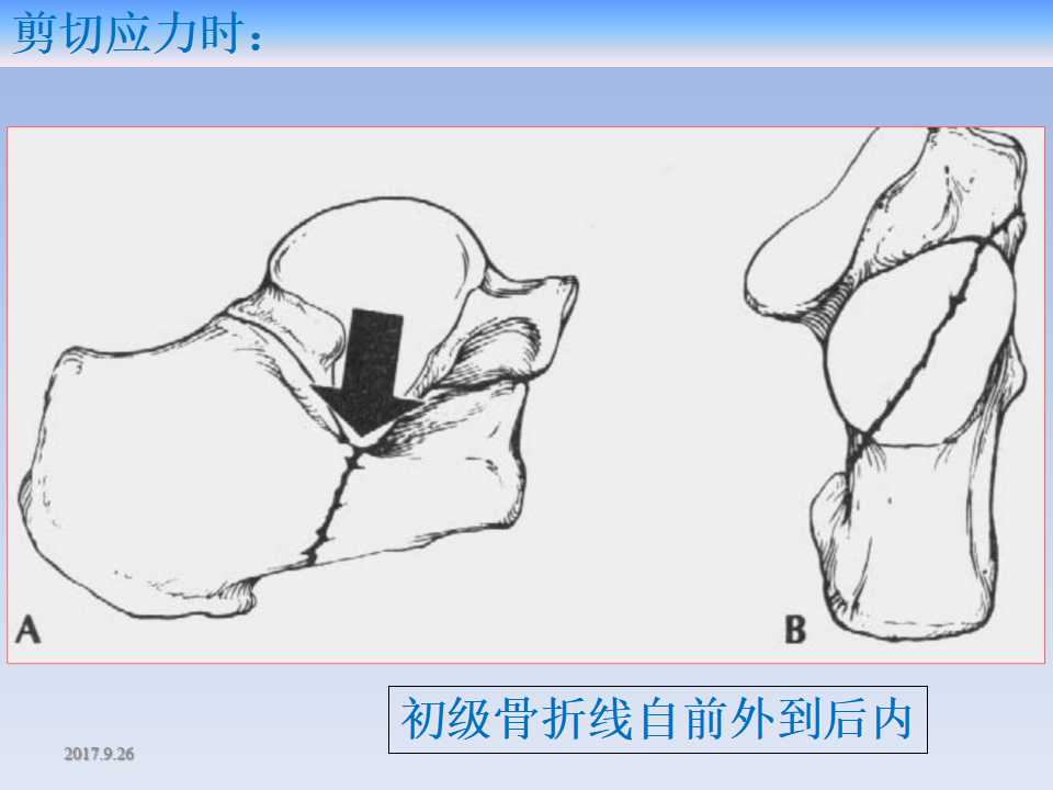 跟骨骨折的临床治疗方式及其要点