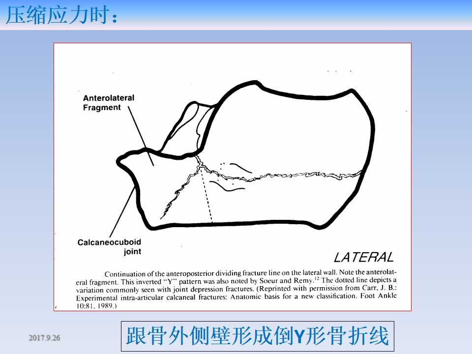 跟骨骨折的临床治疗方式及其要点