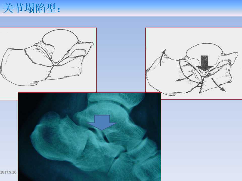 跟骨骨折的临床治疗方式及其要点