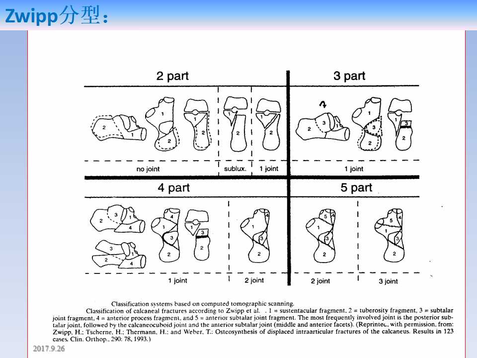 跟骨骨折的临床治疗方式及其要点