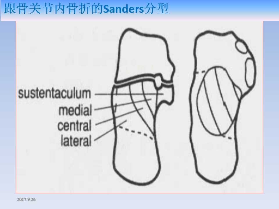 跟骨骨折的临床治疗方式及其要点