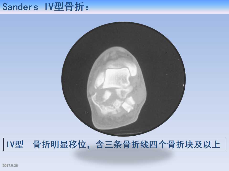 跟骨骨折的临床治疗方式及其要点