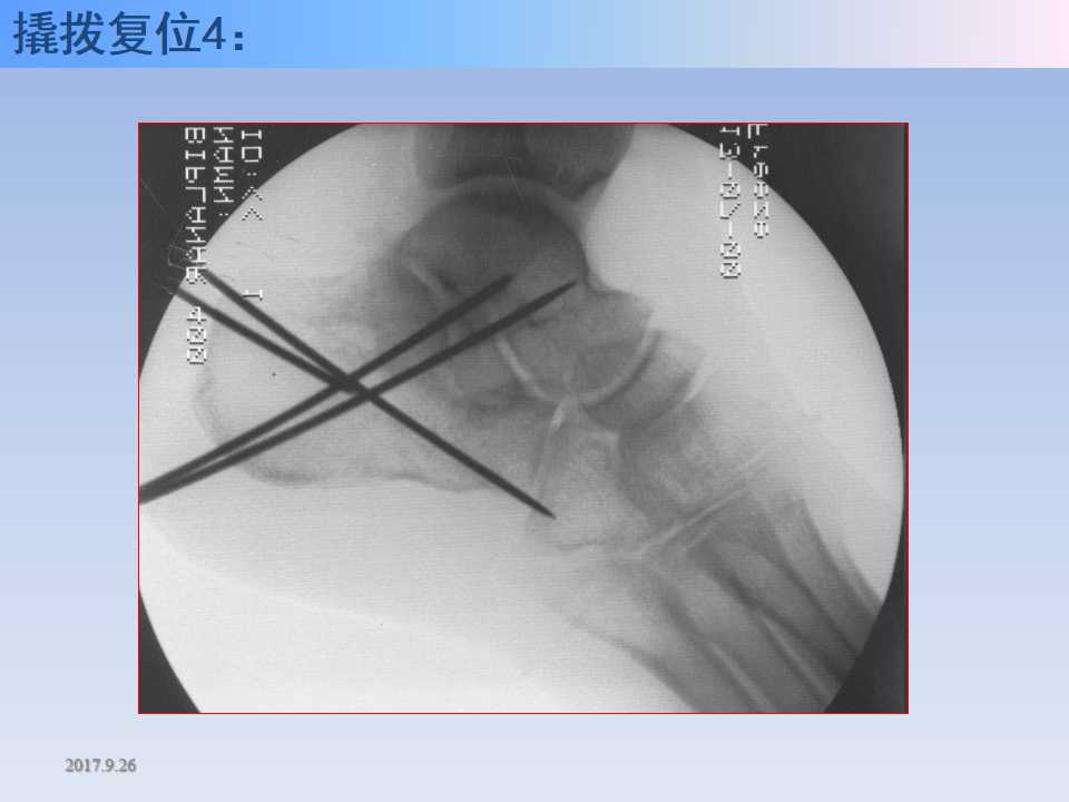 跟骨骨折的临床治疗方式及其要点