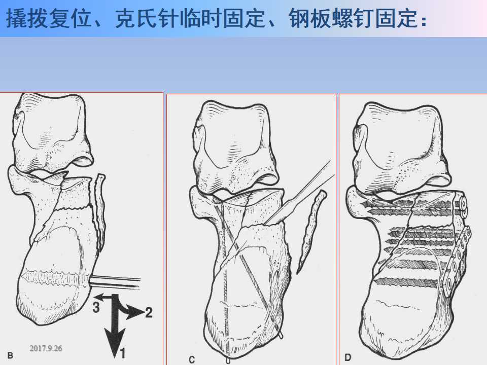 跟骨骨折的临床治疗方式及其要点