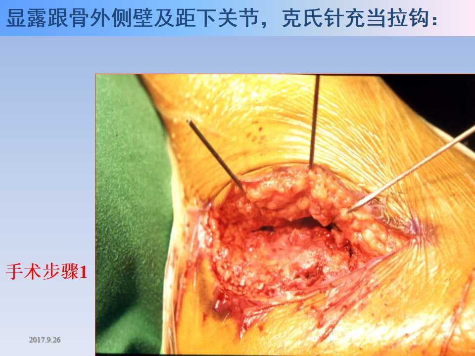 跟骨骨折的临床治疗方式及其要点