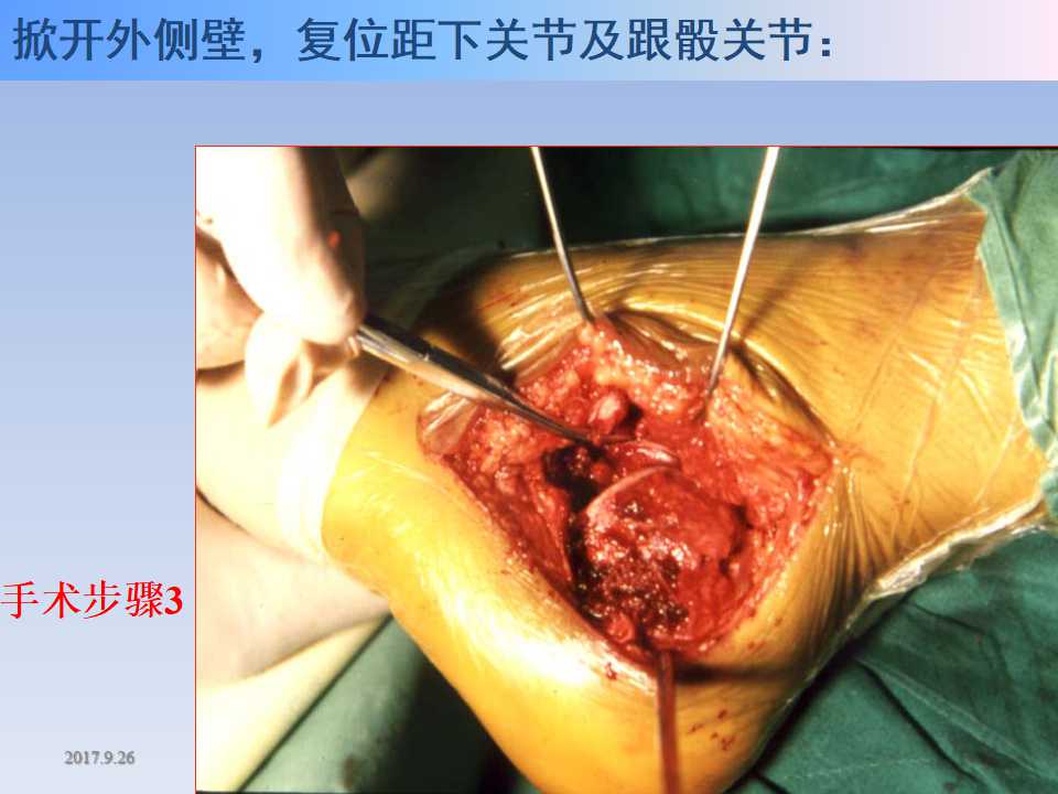 跟骨骨折的临床治疗方式及其要点